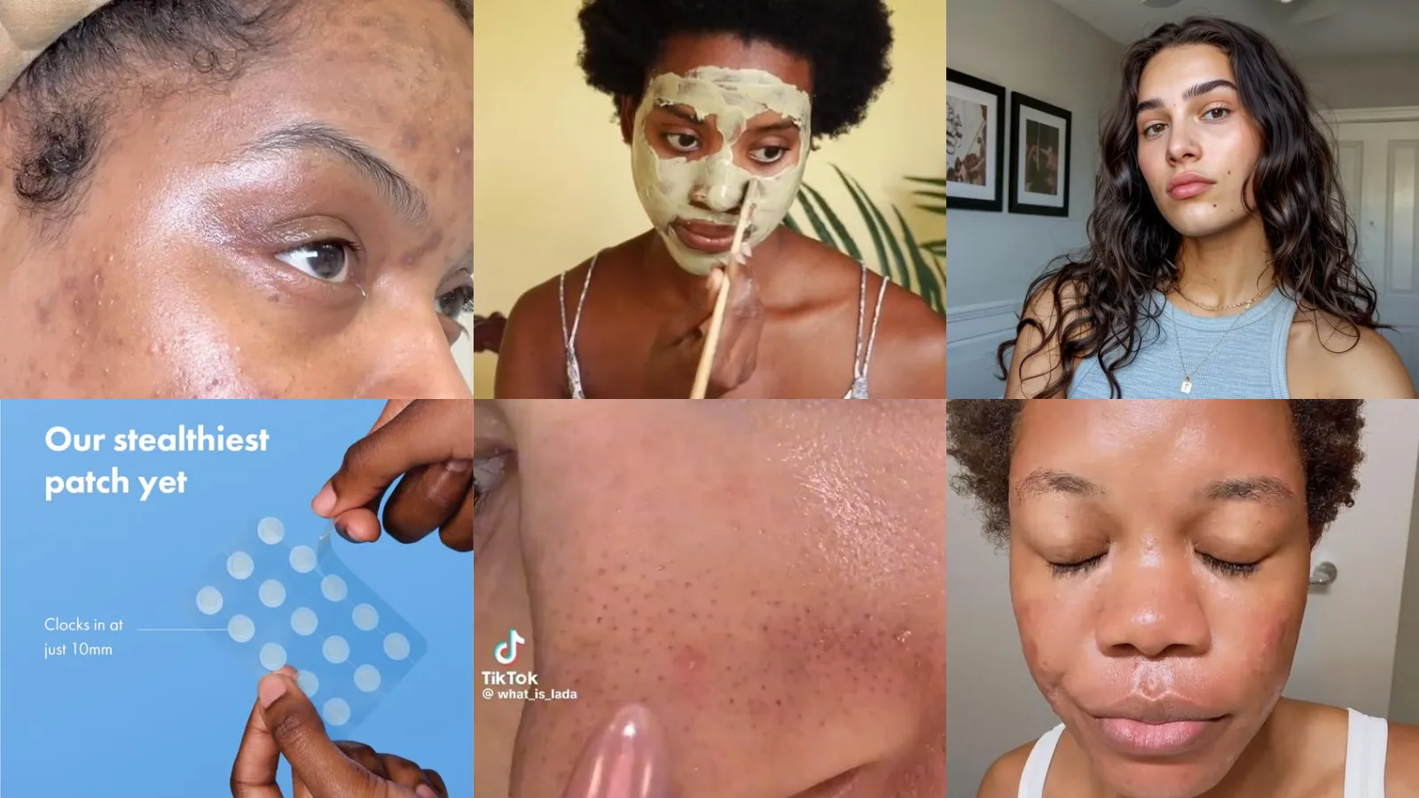 27+ Routine How Treat Acne Breakouts That Actually Work