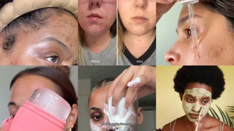 27+ Routine How Treat Acne Breakouts That Actually Work